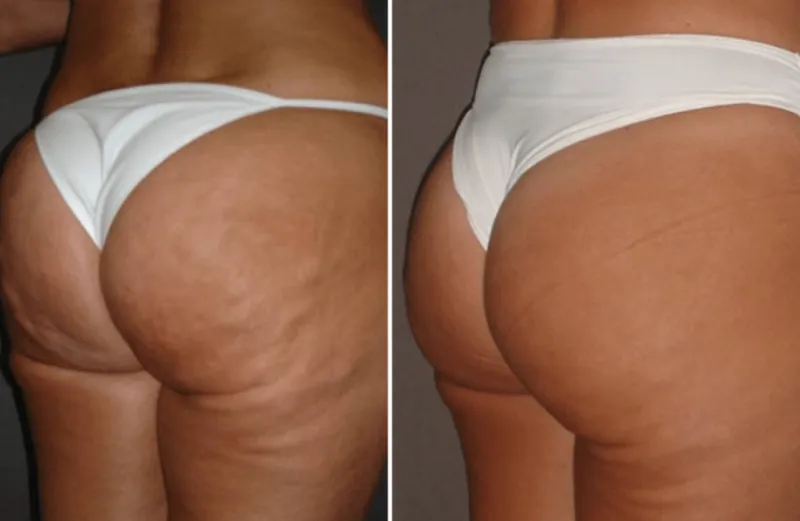 Prima e dopo: glutei