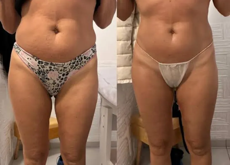 Prima e dopo: pancia e cosce